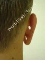 Earlobe Repair Surgery 612298