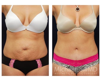 Abdominoplasty - Tummy Tuck before 396148
