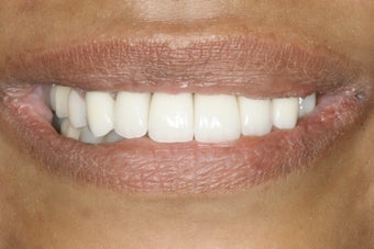 Full Mouth Restoration after 389308