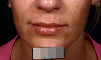 Restylane before 137881