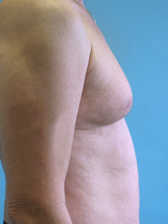 Male Breast Reduction before 229507