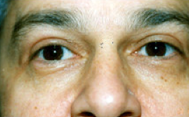 blepahroplasty after 476583