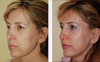 Revision Rhinoplasty before 359000