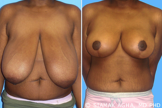 Breast Reduction before 217808