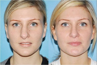 Rhinoplasty before 388996