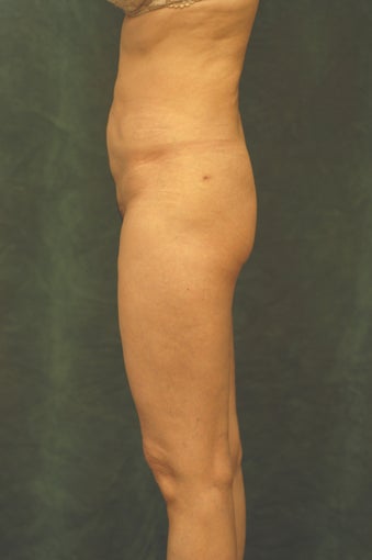Women's Buttocks Augmentation before 518131