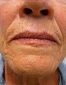 Fraxel Re:pair for Skin Rejuvenation before 196057