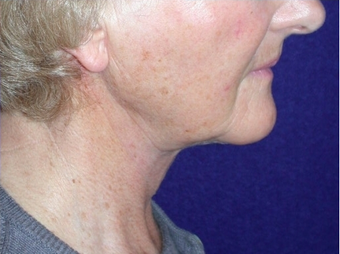 Necklift 208439