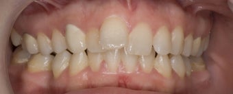 porcelain veneers 363976