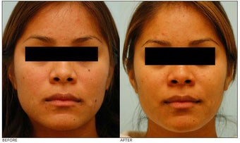 Mole Removal before 138533