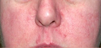 Vbeam for rosacea 374537