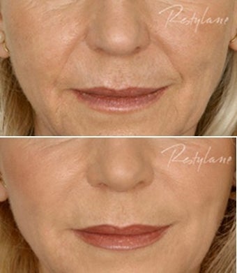 Restylane Nasolabial Folds Before After before 6286