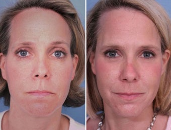 Sculptra filler in Cheeks and Temples before 242561