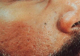 Vbeam for scars before 374584
