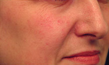 Laser Vein Treatment 349200