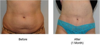 Smart Lipo before 71315