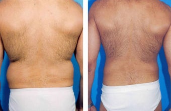 Liposuction before 636266