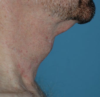 Neck Lift 537418