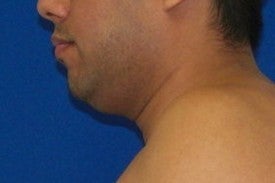 Laser Liposuction before 220264