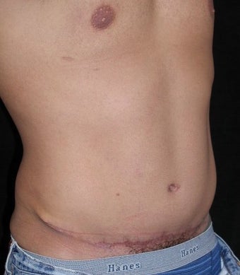 Male tummy Tuck, Flank Liposuction 578199