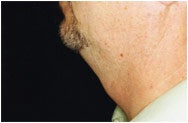 Chin Augmentation before 205406