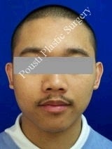 Ear Surgery (Otoplasty) 616645