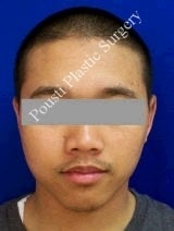 Ear Surgery (Otoplasty) 616645
