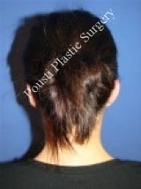 Ear Surgery (Otoplasty) after 616652