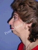 Chin Implants 622585