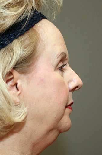 Chin Implant 633285