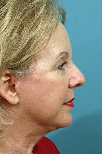 Chin Implant 633285