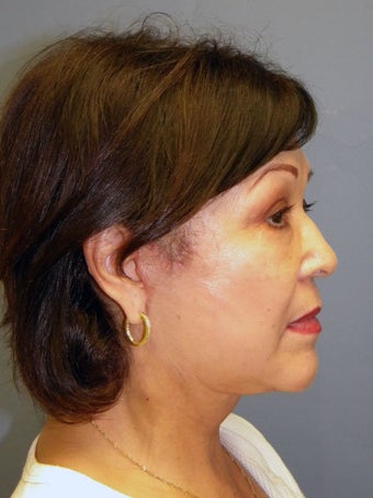 Neck Lift, Platysmaplasty 634728