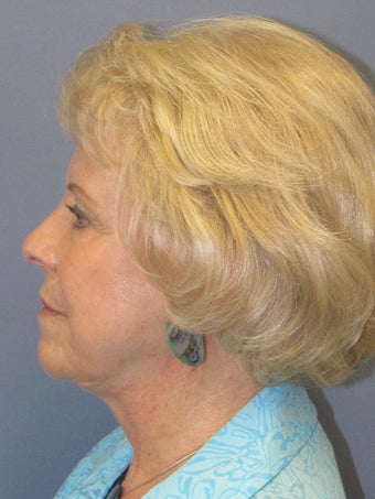 Obagi Blue Peel 635087