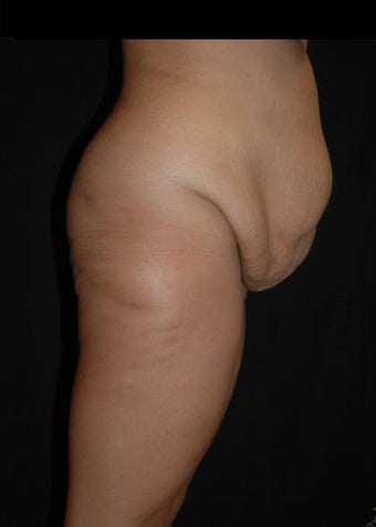 29 year old female treated for excess skin and weight. 640860