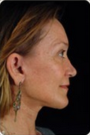 Face and neck lift 6744