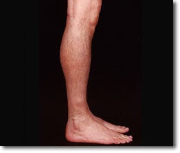Calf Implant 566013