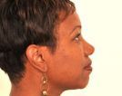 Chin Augmentation 379502