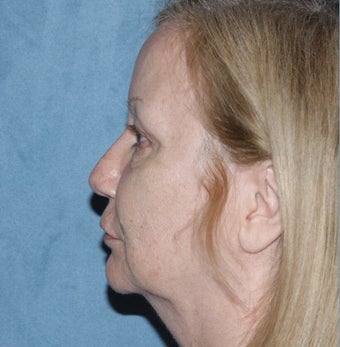 Neck Lift before 341213