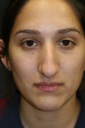 Rhinoplasty and Septoplasty before 527291