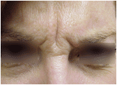 Botox before 267385