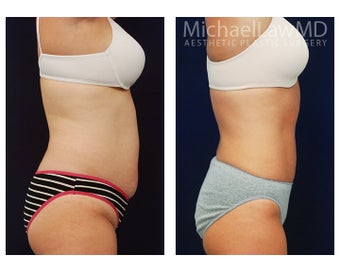Liposuction 495015