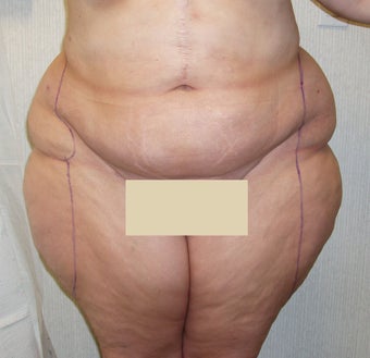 Liposuction Abdomen and Thighs before 55473