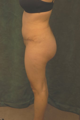 Women's Buttocks Augmentation after 518152