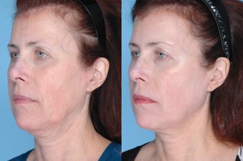 Ulthera Full Face and Neck after 378866