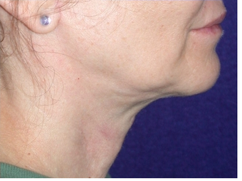 Necklift 208447