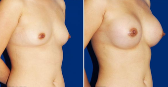 Breast Implants after 494488