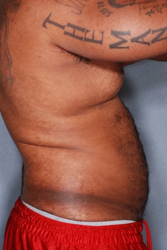 SmartLipo Breasts & Abs 356667