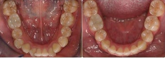 Extraction and space closure before 547361