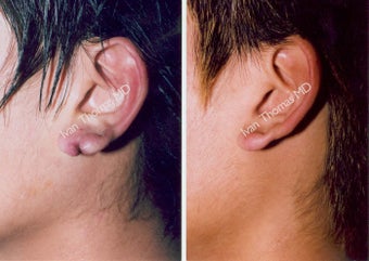 Earlobe Surgery before 243343