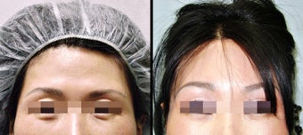 Lower Eyelid(Blepharoplasty) Surgery before 650653